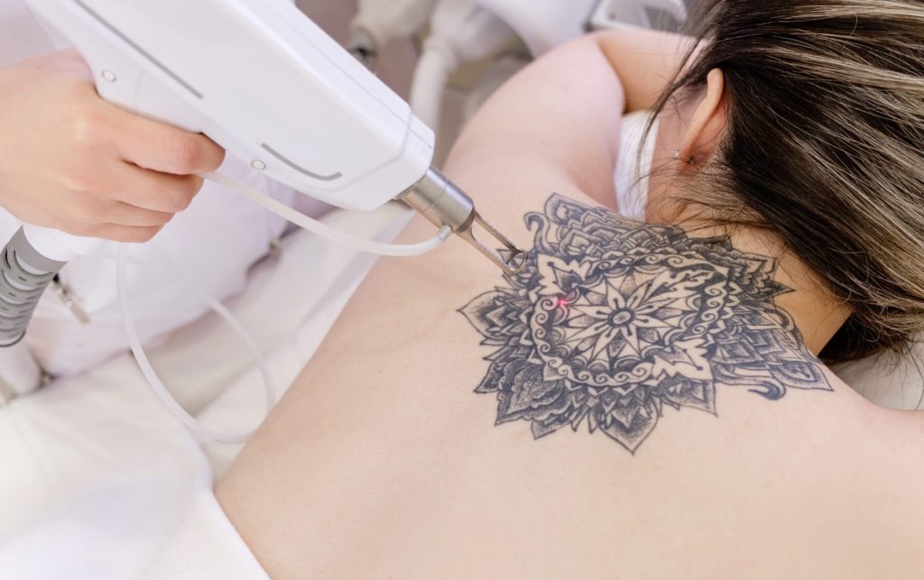 Tattoo Laser Removal